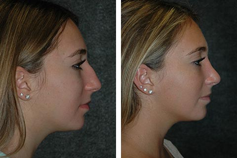 Best Closed Rhinoplasty Photos