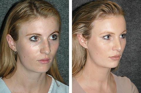 best eastern european rhinoplasty surgeon results dr jacono