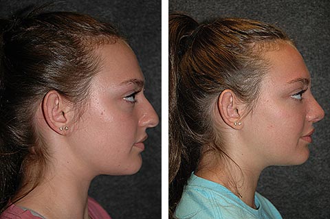 best rhinoplasty surgeon before after dr jacono best rhinoplasty surgeon before after dr jacono
