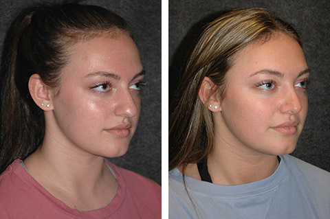 best rhinoplasty surgeon before after photos dr jacono best rhinoplasty surgeon before after photos dr jacono