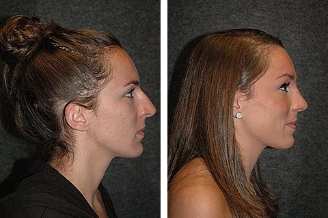 best rhinoplasty surgeon dr jacono new york city