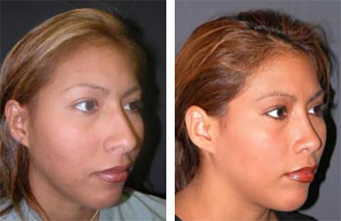 best rhinoplasty surgeon in the world photos