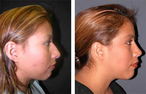 best rhinoplasty surgeon in the world