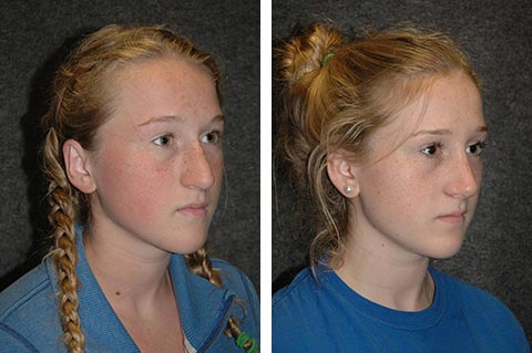 best teen rhinoplasty surgeon in america best teen rhinoplasty surgeon in america