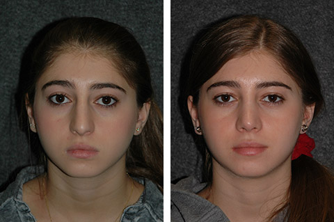 teen rhinoplasty before after photos front