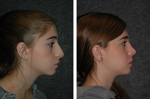 closed rhinoplasty before after photos profile