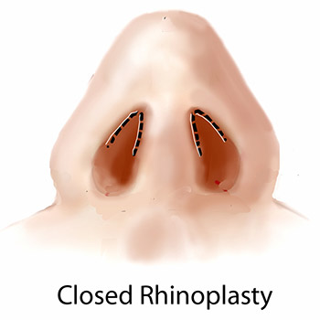 closed rhinoplasty diagram