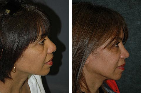 hispanic rhinoplasty before and afters