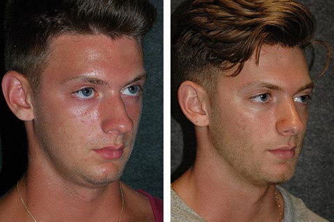 male celebrity rhinoplasty before and after