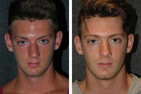 male closed rhinoplasty before and afters