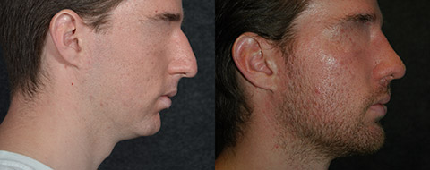 Male Nose Job with Chin Augmentation