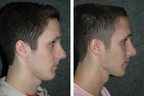 Male Nose Job Profile Photo