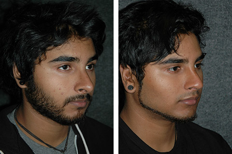 Male Nose Job Before and After Photo