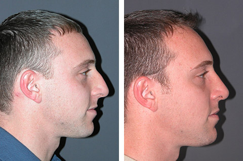 Male Rhinoplasty Before and After Photos