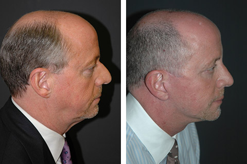 Male Rhinoplasty Before and After