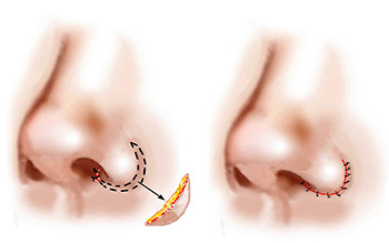 Nostril Reduction Surgery