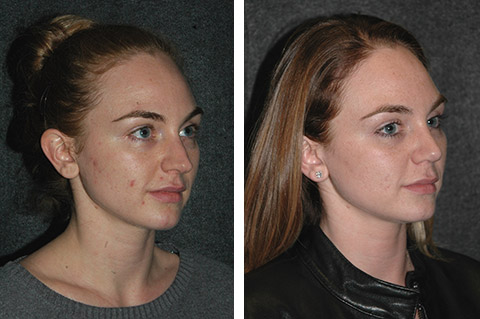 open rhinoplasty before and after pics