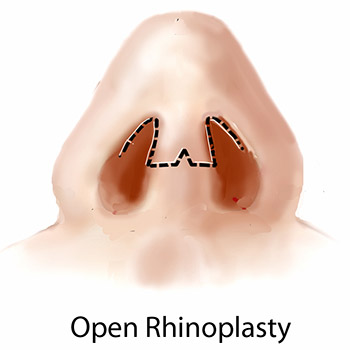 open rhinoplasty diagram