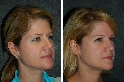 open rhinoplasty for women new york city