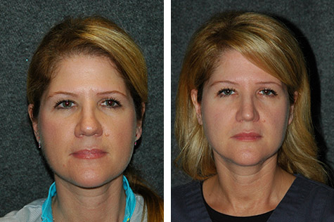 open rhinoplasty for women new york