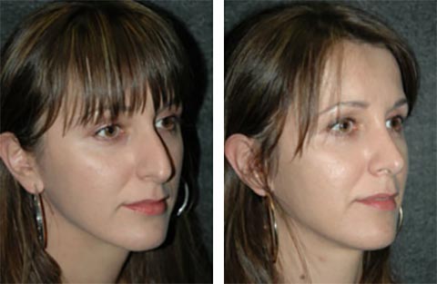 worlds best rhinoplasty surgeon