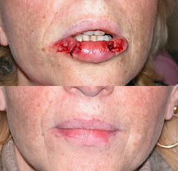 Dog Bite Lip Reconstruction Patient Photo