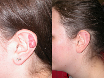 Keloid Scar Removal Patient Photo