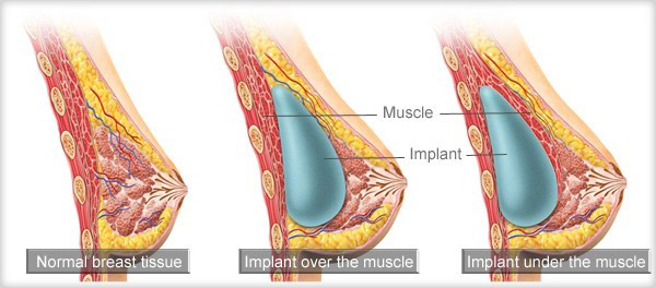 Anatomy of a Breast - How Breast Implants Work