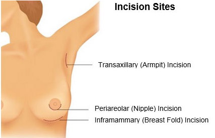 Breast Augmentation Incision Illustration