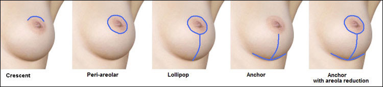 Breast Lift Smithtown, Long Island - Mastopexy Surgery Suffolk County