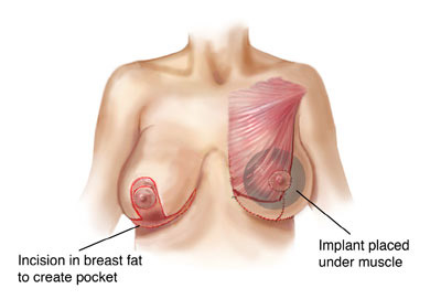 Breast Lift with Implants Illustration