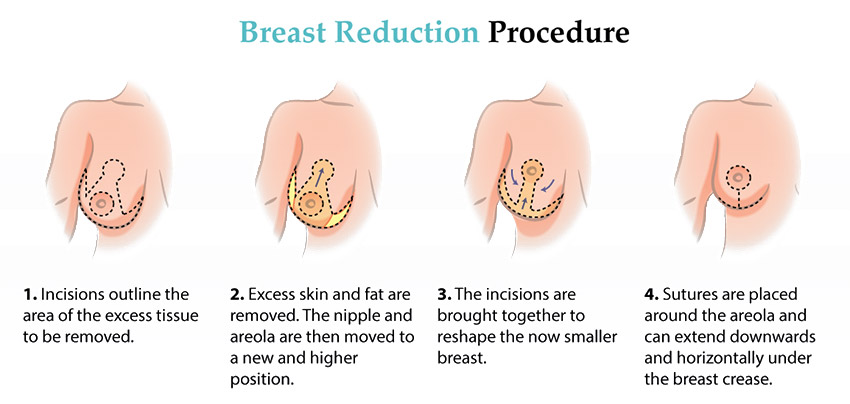 breast reduction procedure illustrated