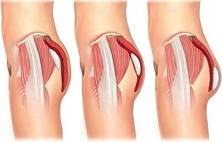 butt augmentation illustration