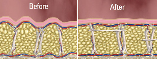 cellfina before and after cellulite treatment