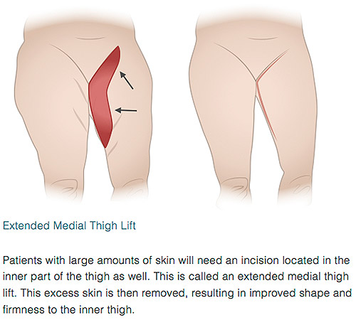 Extended Thigh Lift Illustration