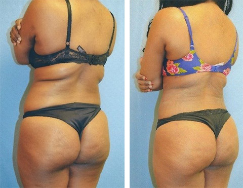 Liposuction Before and After Patient photos