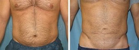 Male Liposuction Photo Long Island, NY