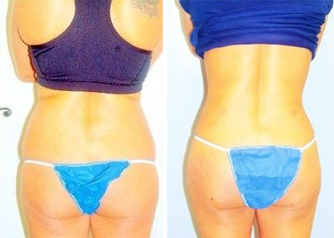 Long Island Liposuction Before & After Photo