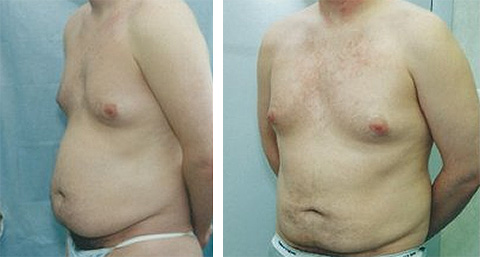 male liposuction