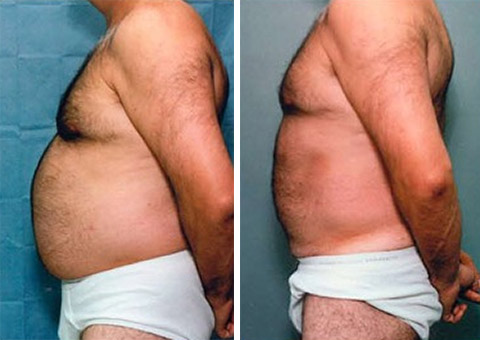 Male Lipo Before & After Photo