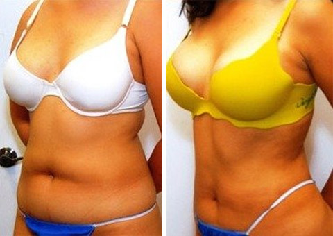 New York Liposuction Before and After Photo