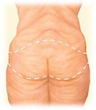 Lower Body Lift Posterior Illustration