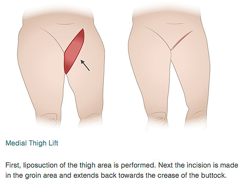 Medial Thigh Lift Illustration