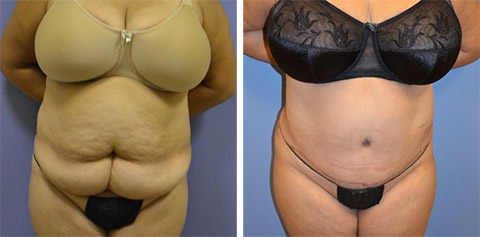 Tummy Tuck Long Island  Abdominoplasty by Dr. Alizadeh