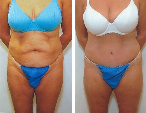 Tummy Tuck Long Island  Best Abdominoplasty Long Island