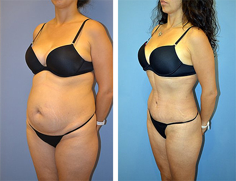 Tummy Tuck in NYC, Abdominoplasty