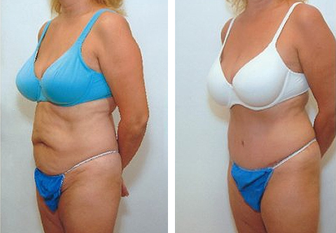 Abdominoplasty  Best Tummy Tuck Results New York