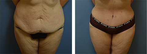 new york abdominoplasty