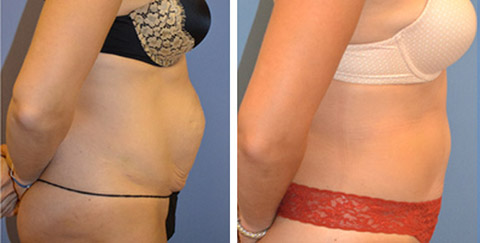 Abdominoplasty  Best Tummy Tuck Results New York