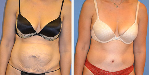 tummy tuck long island